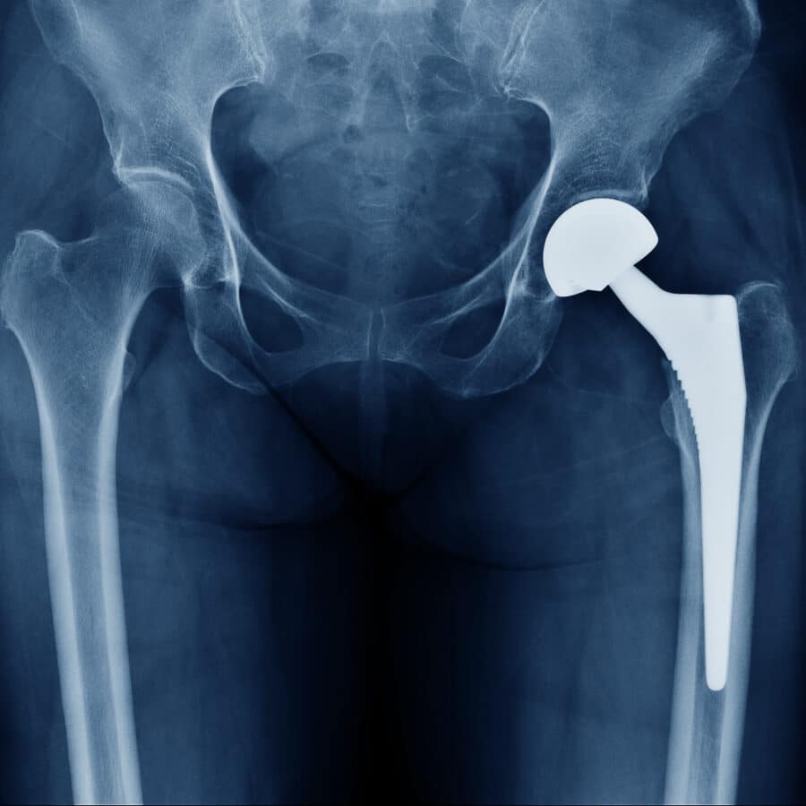 Hip Implant X-Ray